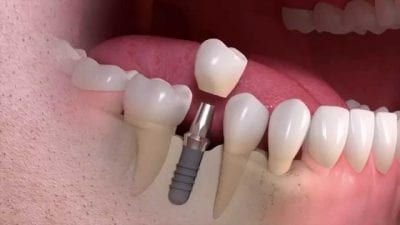Dental implant process: a tooth crown being placed on a metal post in the jaw, surrounded by natural teeth.