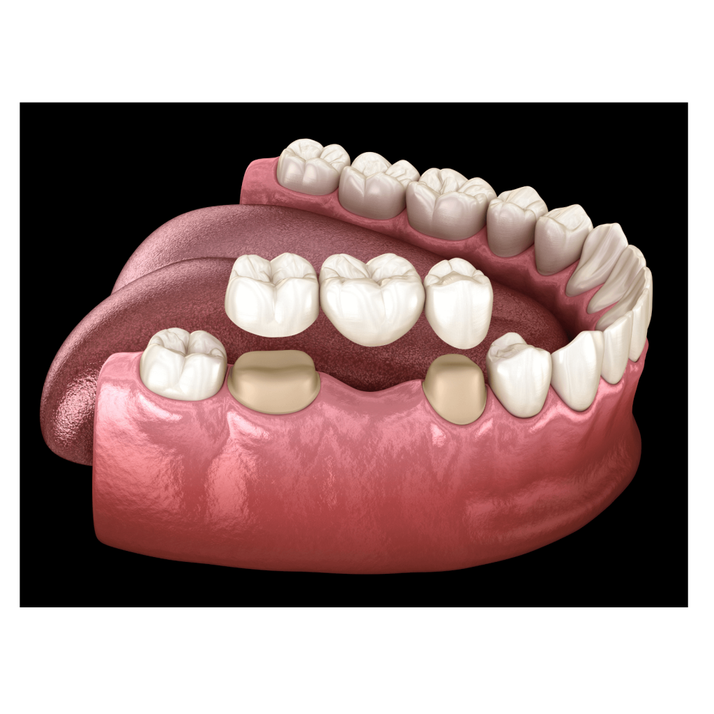 Dental model showing upper and lower teeth, including molars and crowns, inside the mouth.