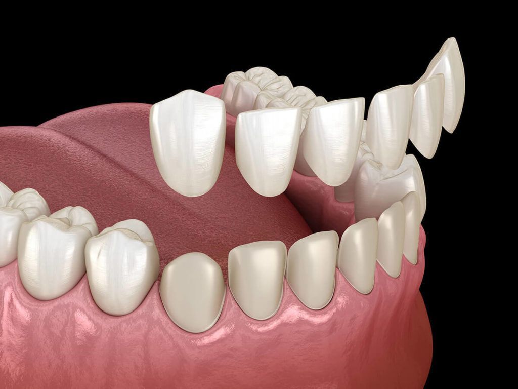 Dental model showing porcelain veneers being applied to upper teeth.