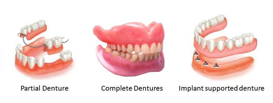 Types of dentures: partial, complete, and implant-supported, each illustrated with a visual depiction.