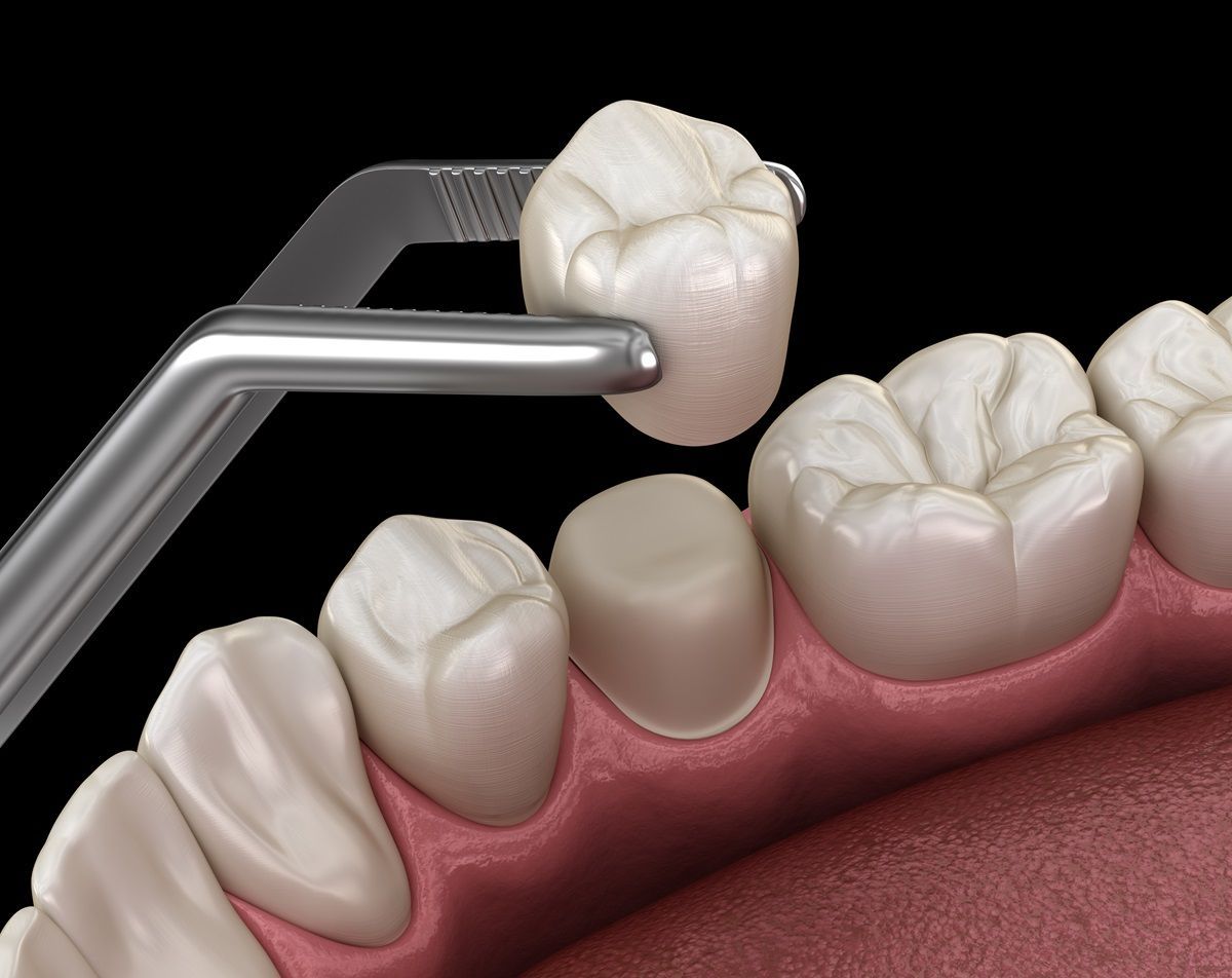 Dental crown being placed onto a prepared tooth with a metal tool, dental setting.