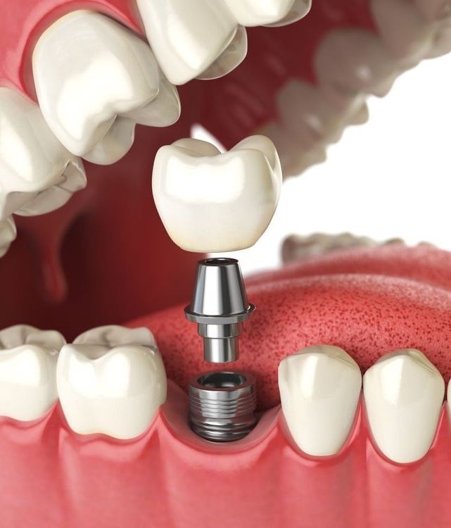 A Close Up of a Dental Implant in a Person 's Mouth — Bytes of Byron–Bio Holistic Dentistry in Byron Bay, NSW