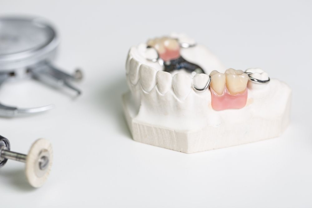 A Model of a Tooth With a Dental Bridge on It — Bytes of Byron–Bio Holistic Dentistry in Northern Rivers, NSW