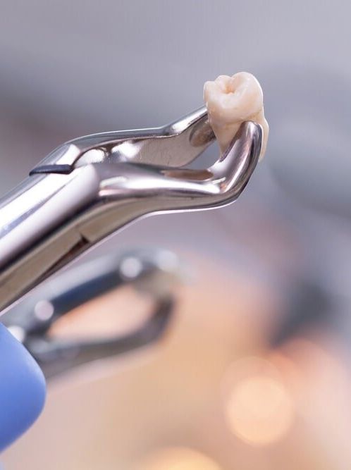 A Person is Holding a Pair of Dental Pliers With a Tooth in It — Bytes of Byron–Bio Holistic Dentistry in Byron Bay, NSW