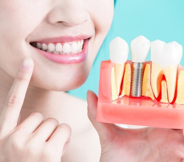 A Woman is Holding a Model of a Dental Implant in Her Hand — Bytes of Byron–Bio Holistic Dentistry in Byron Bay, NSW