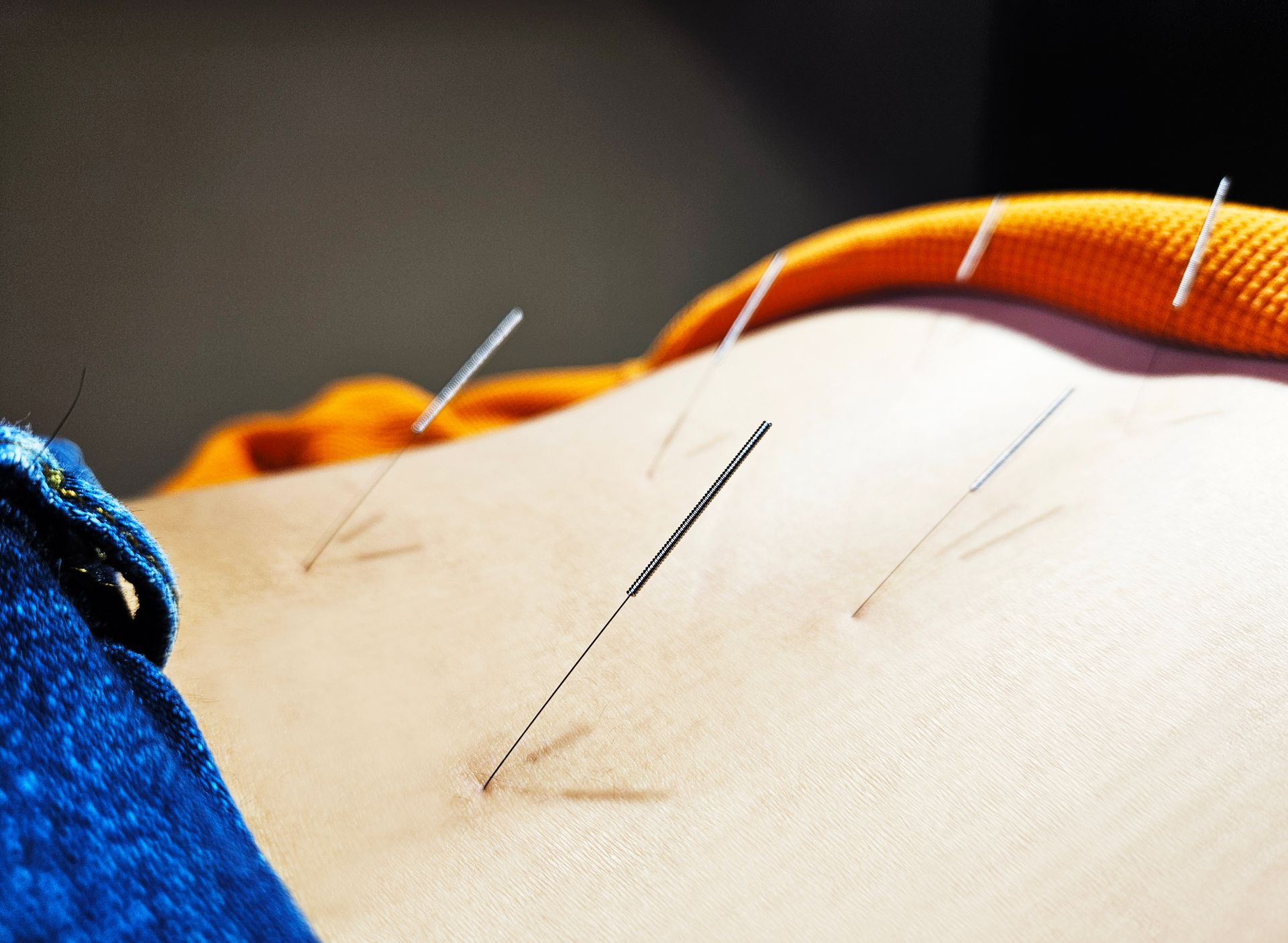 A person is getting acupuncture on their back