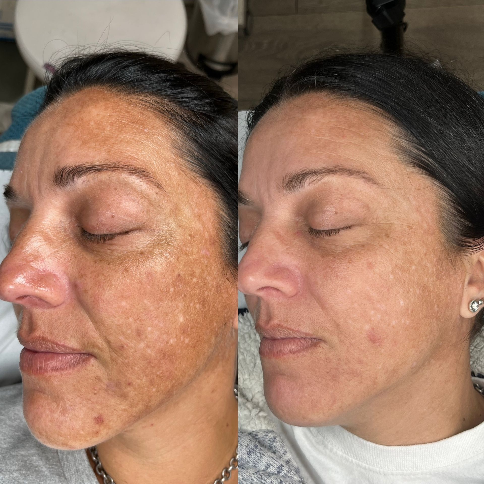 skinpen microneedling