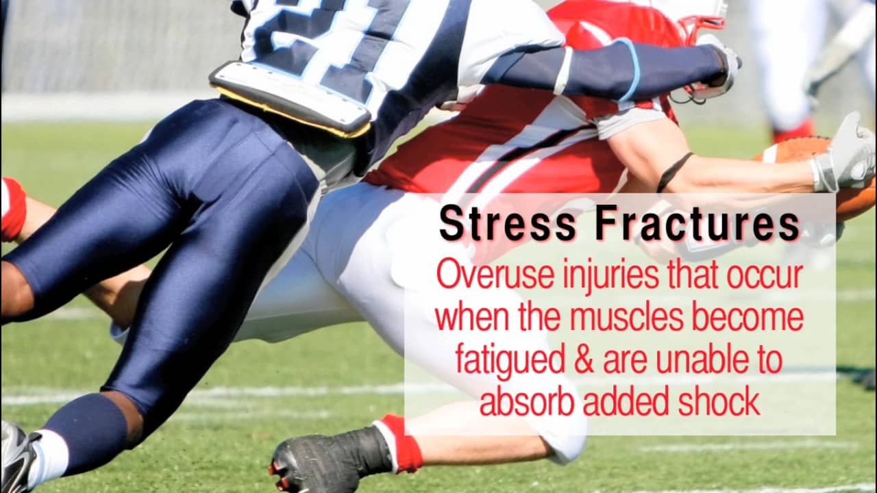 Stress Fractures