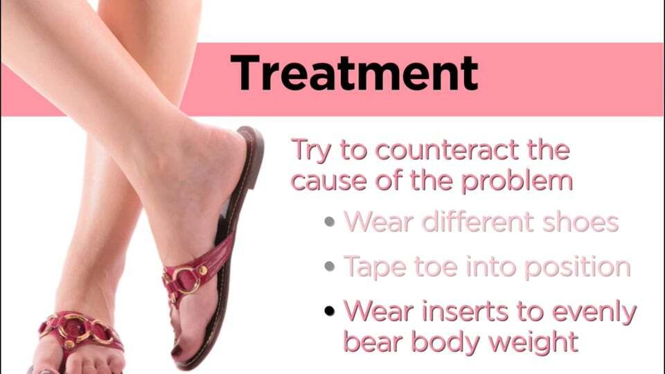 Bunions