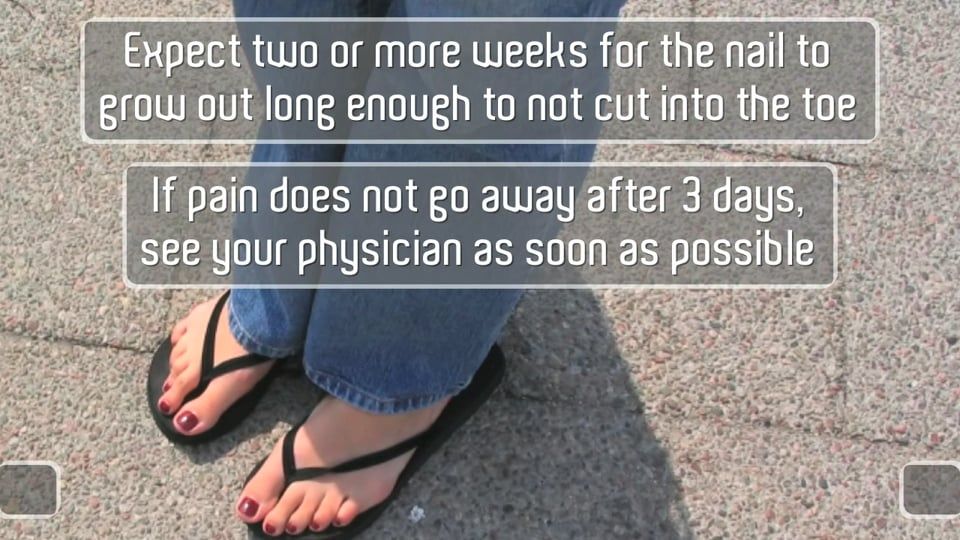 Ingrown Toenails