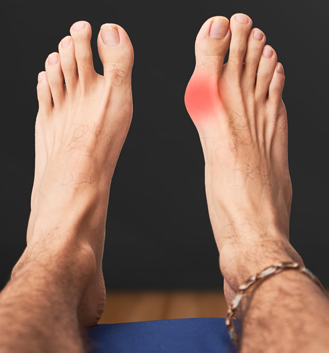 Capsulitis