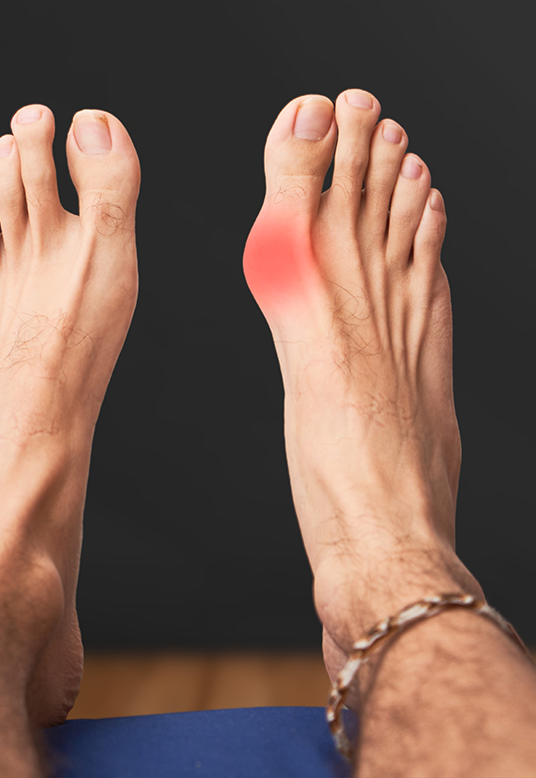 Capsulitis