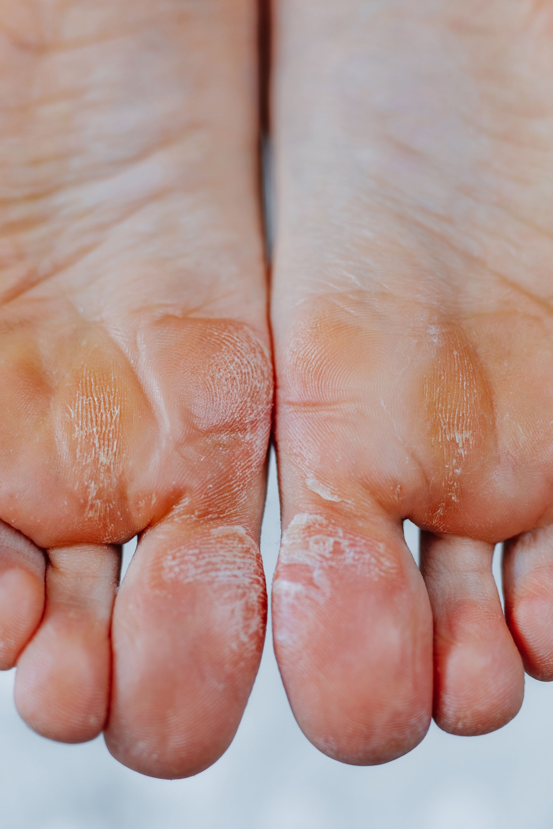 Psoriasis