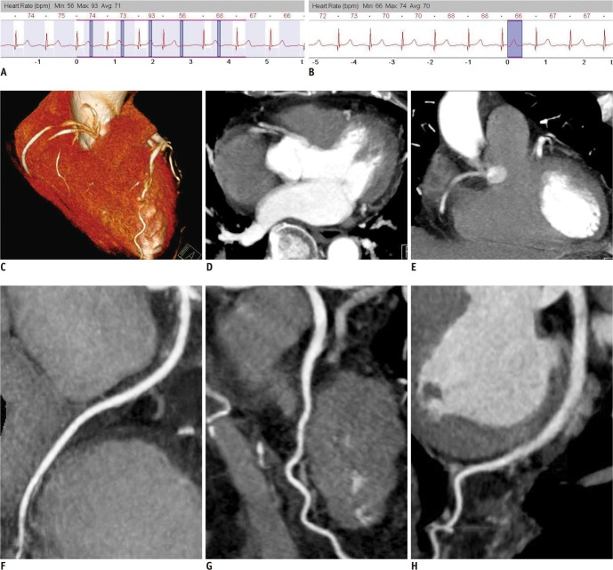 A picture of a heart and a picture of a heart with an ecg