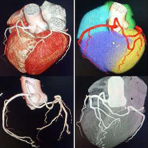 A collage of four images of a heart with different colored veins.