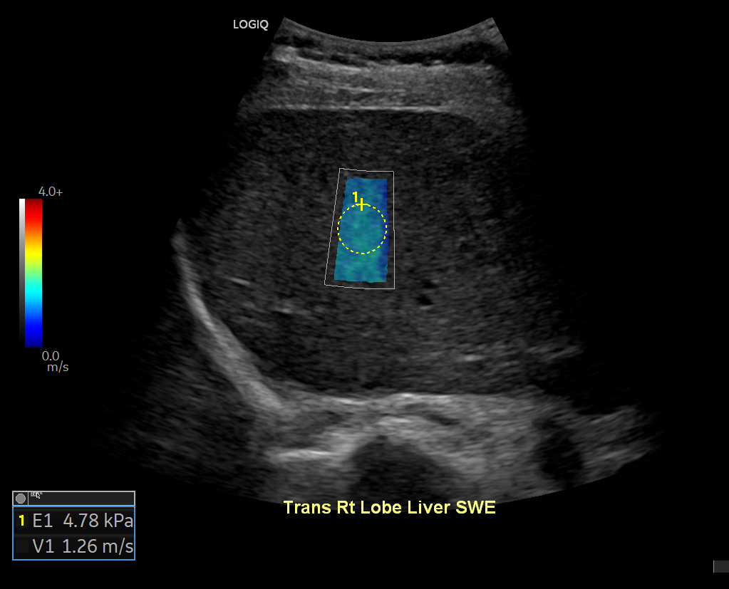 An ultrasound of a liver with a blue square in the middle
