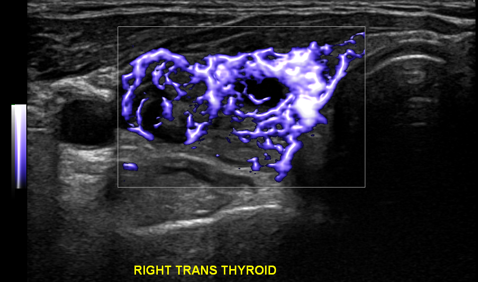 A black and white image of a right trans thyroid