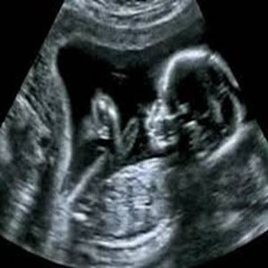 An ultrasound of a baby in the womb of a woman.
