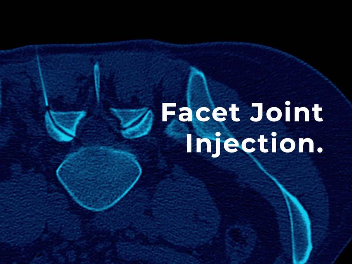 A ct scan of a facet joint injection