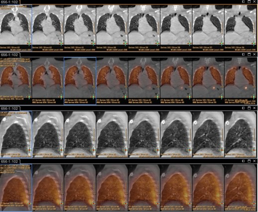A bunch of pictures of a person 's lungs on a computer screen