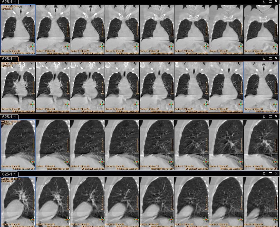 A series of black and white images of a person 's lungs