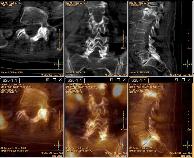 A collage of four images of a person 's spine