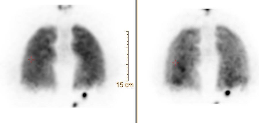 A pair of black and white images of a person 's lungs.