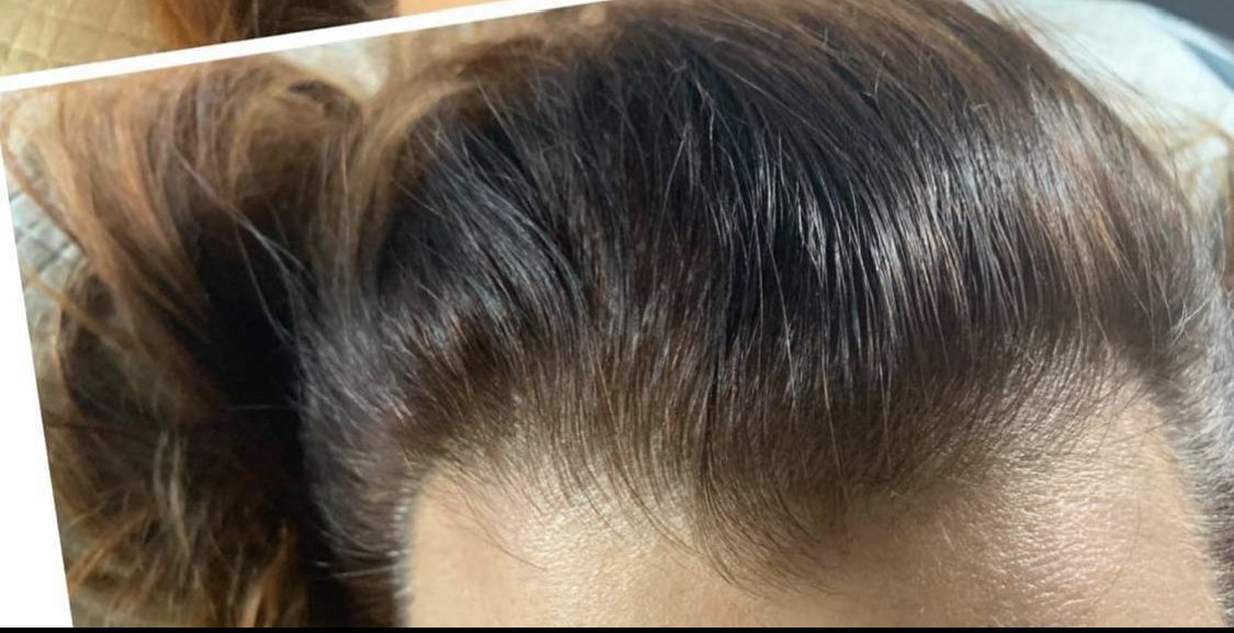 Cryoskin and scalp micro pigmentation result