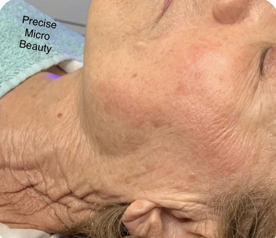 Cryoskin Treatment Clinton Township