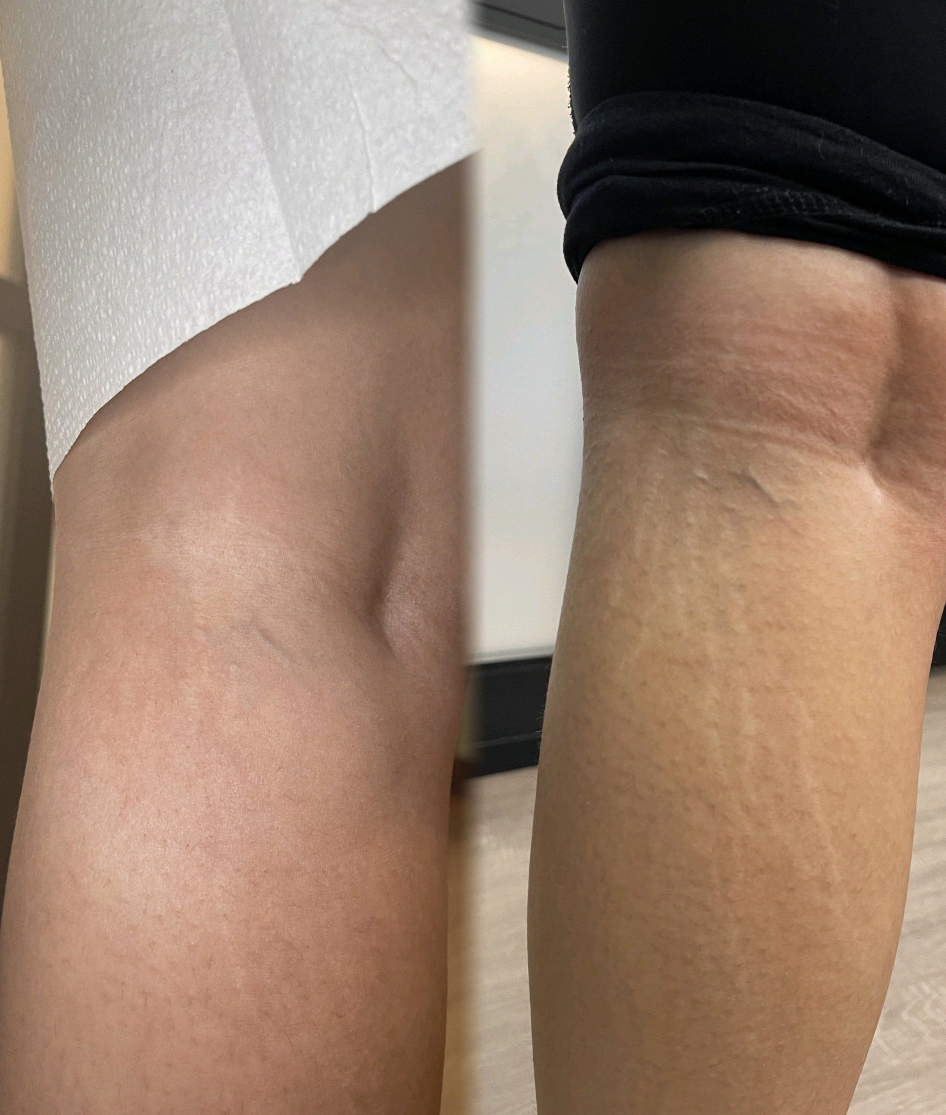 Stretch Mark/Scar Camouflage treatment