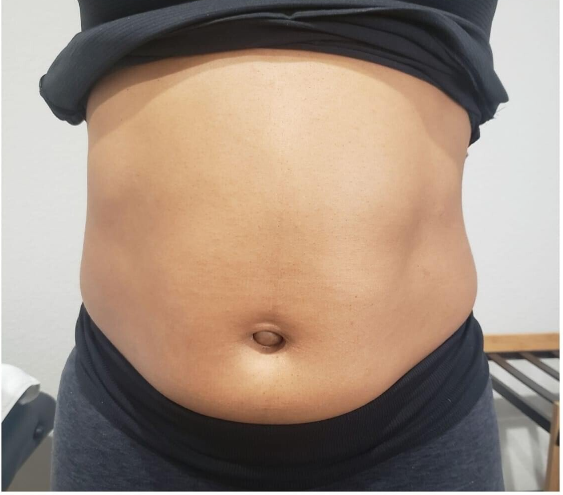 Cryoskin result before and after