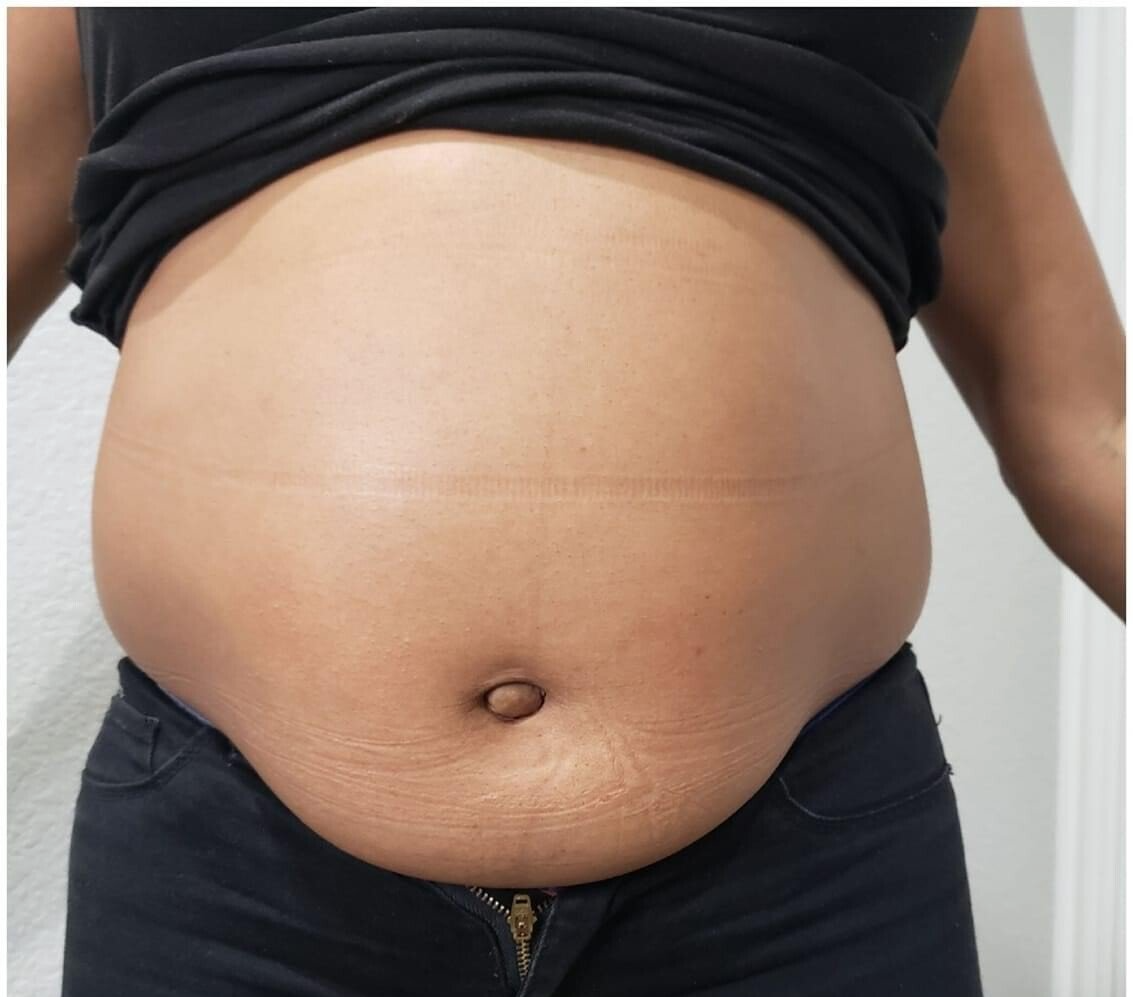 Cryoskin before and after
