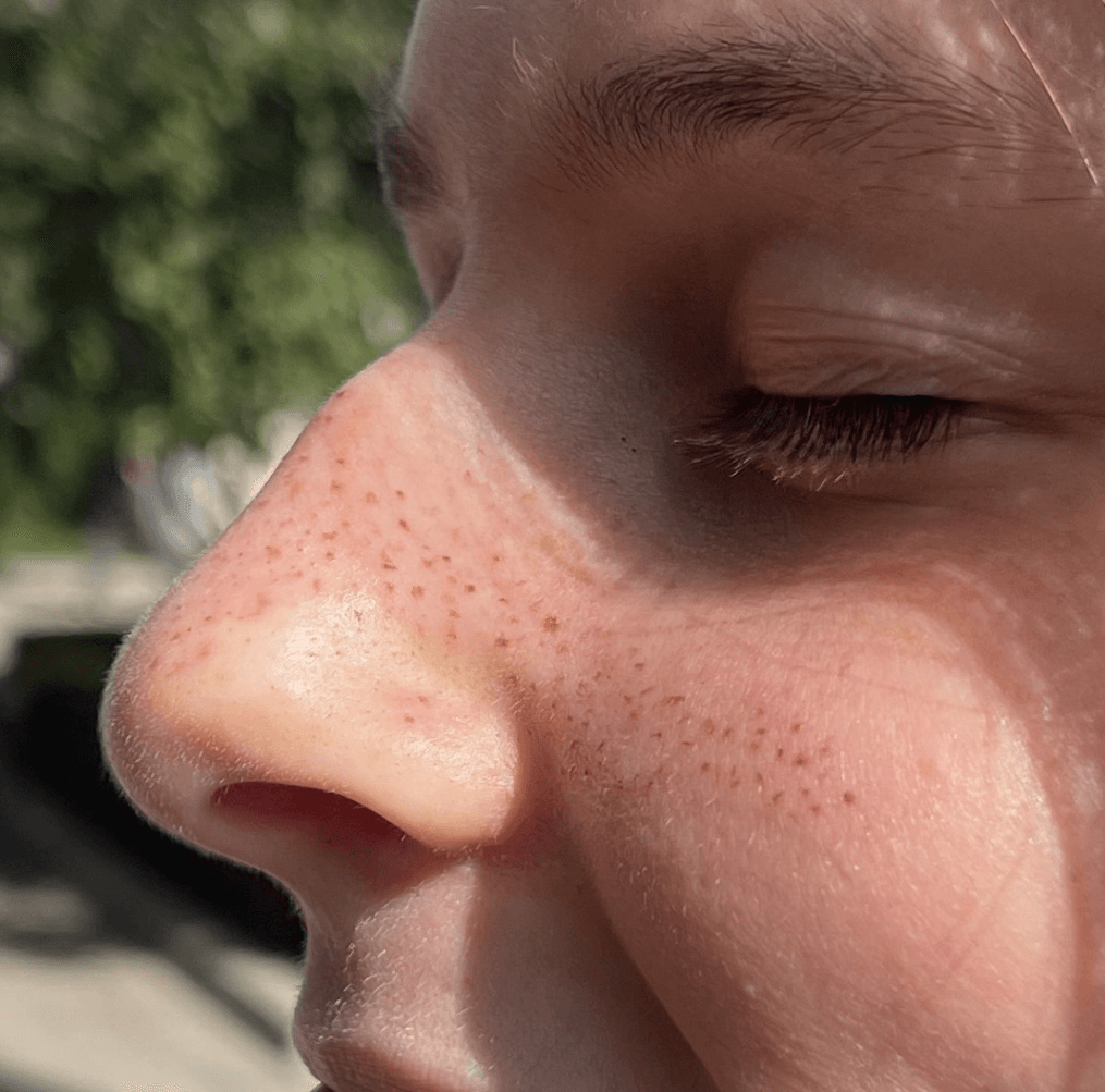 Cryoskin and scalp micro pigmentation result