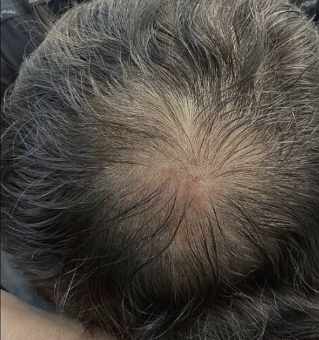 Scalp Micropigmentation treatment Clinton Township