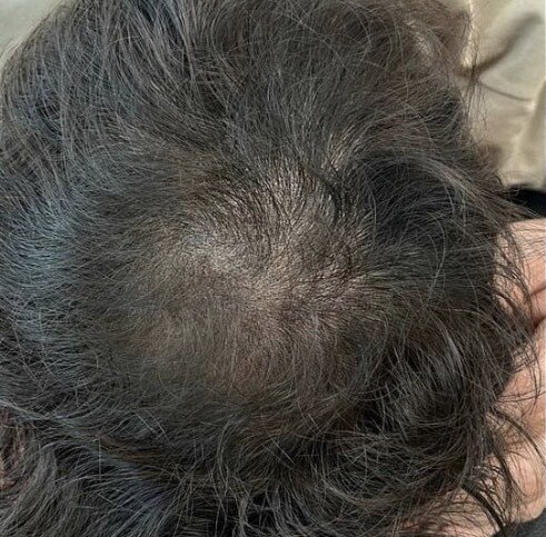 Scalp Micropigmentation treatment result