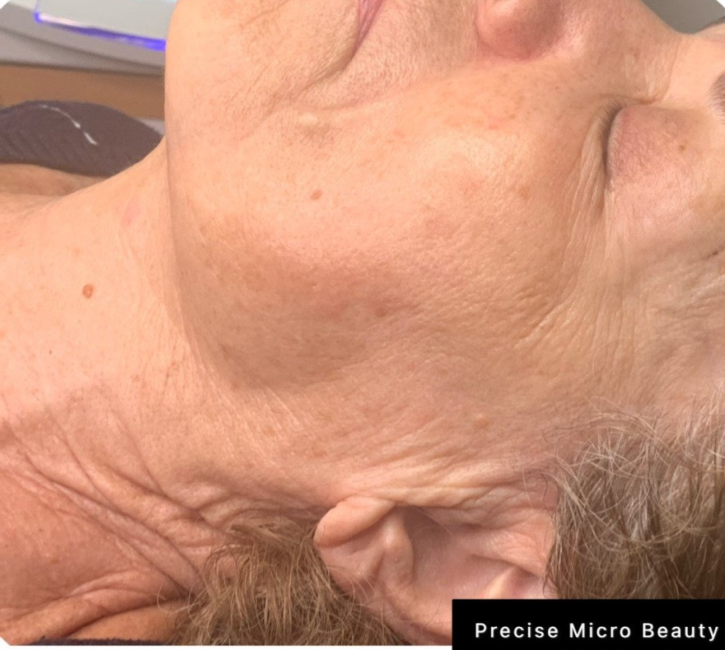 Cyroskin treatment results