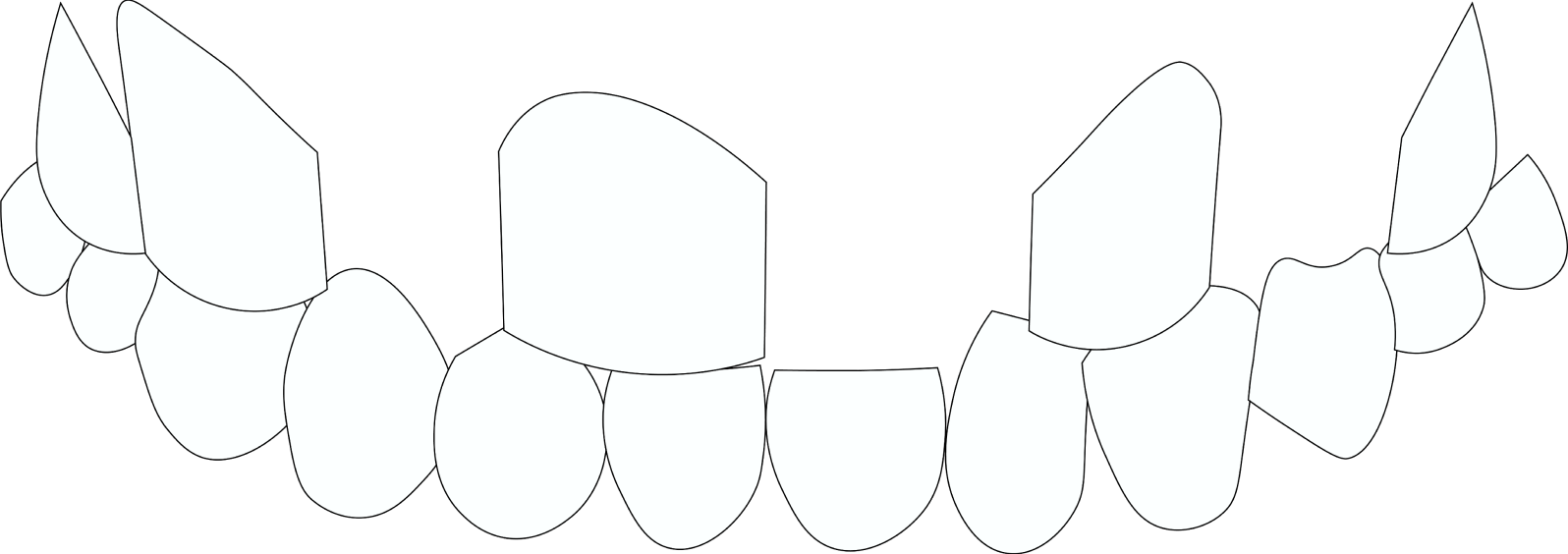 Missing Teeth Due to Gum Disease