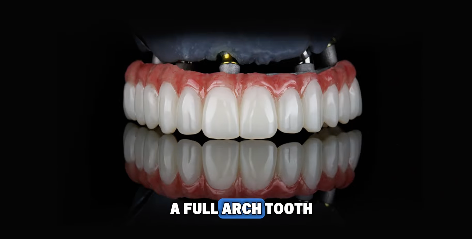 Set of Top Arch zirconia implant teeth