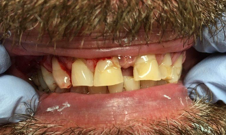 Gapped teeth before