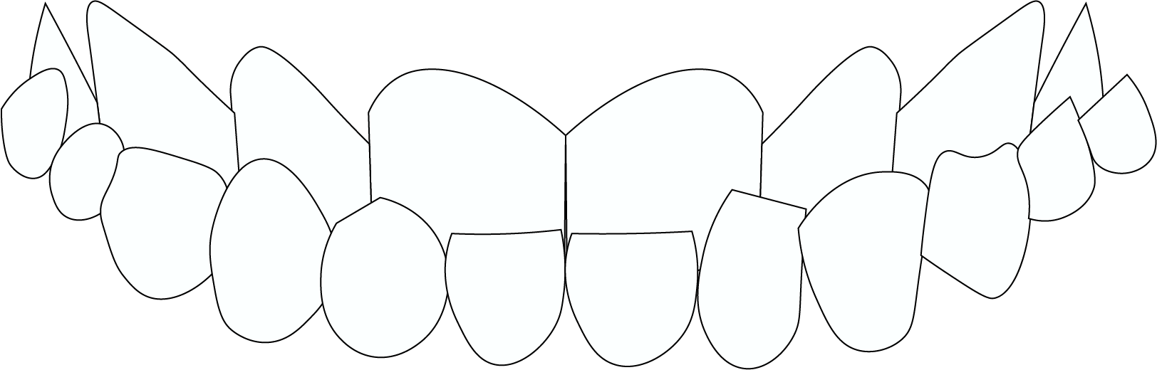 Underbite