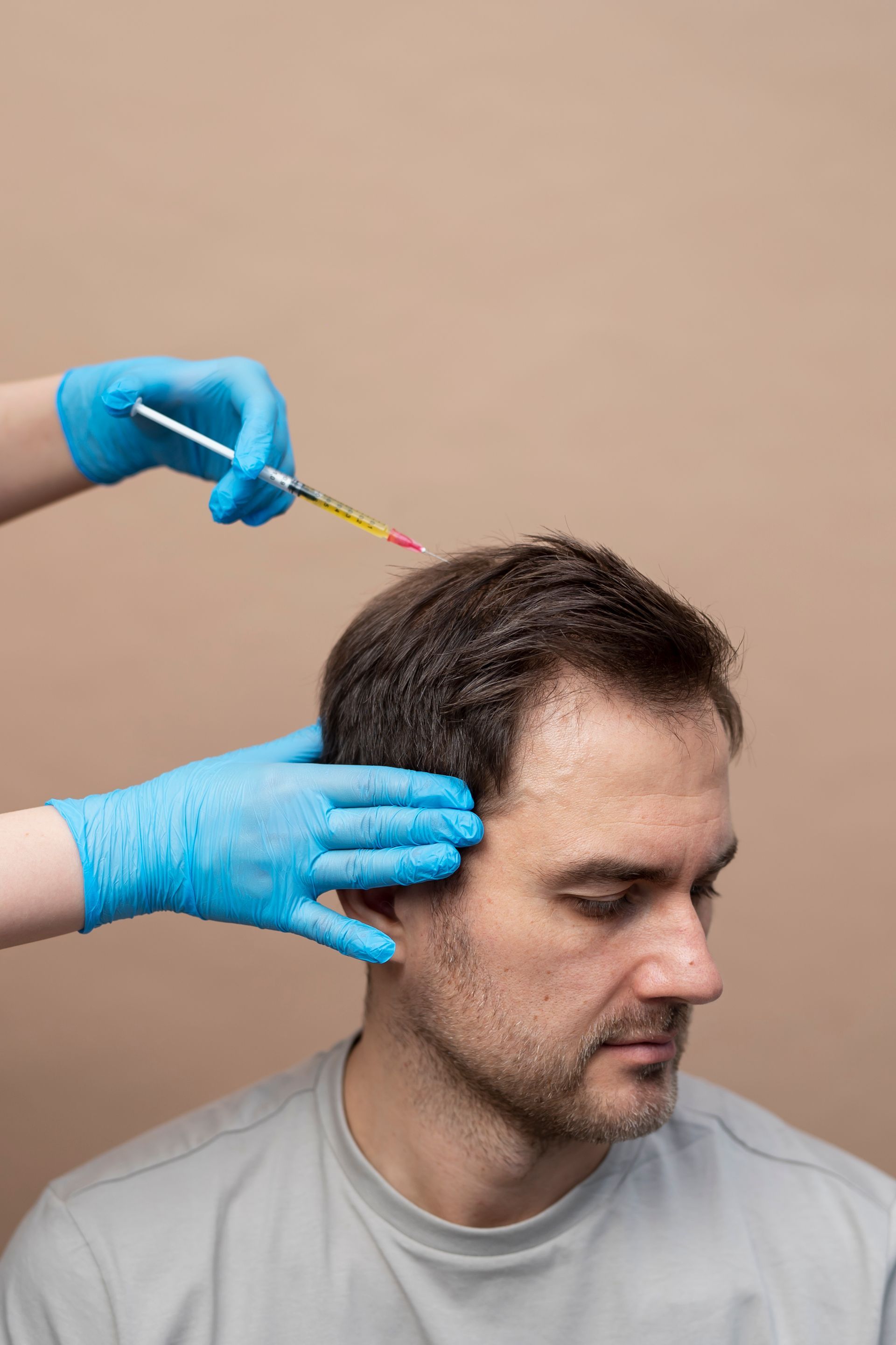 PRP for hair treatment on male