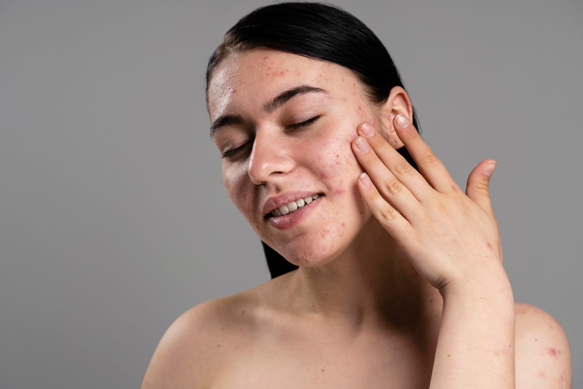 A woman with acne on her face is touching her face with her hand.