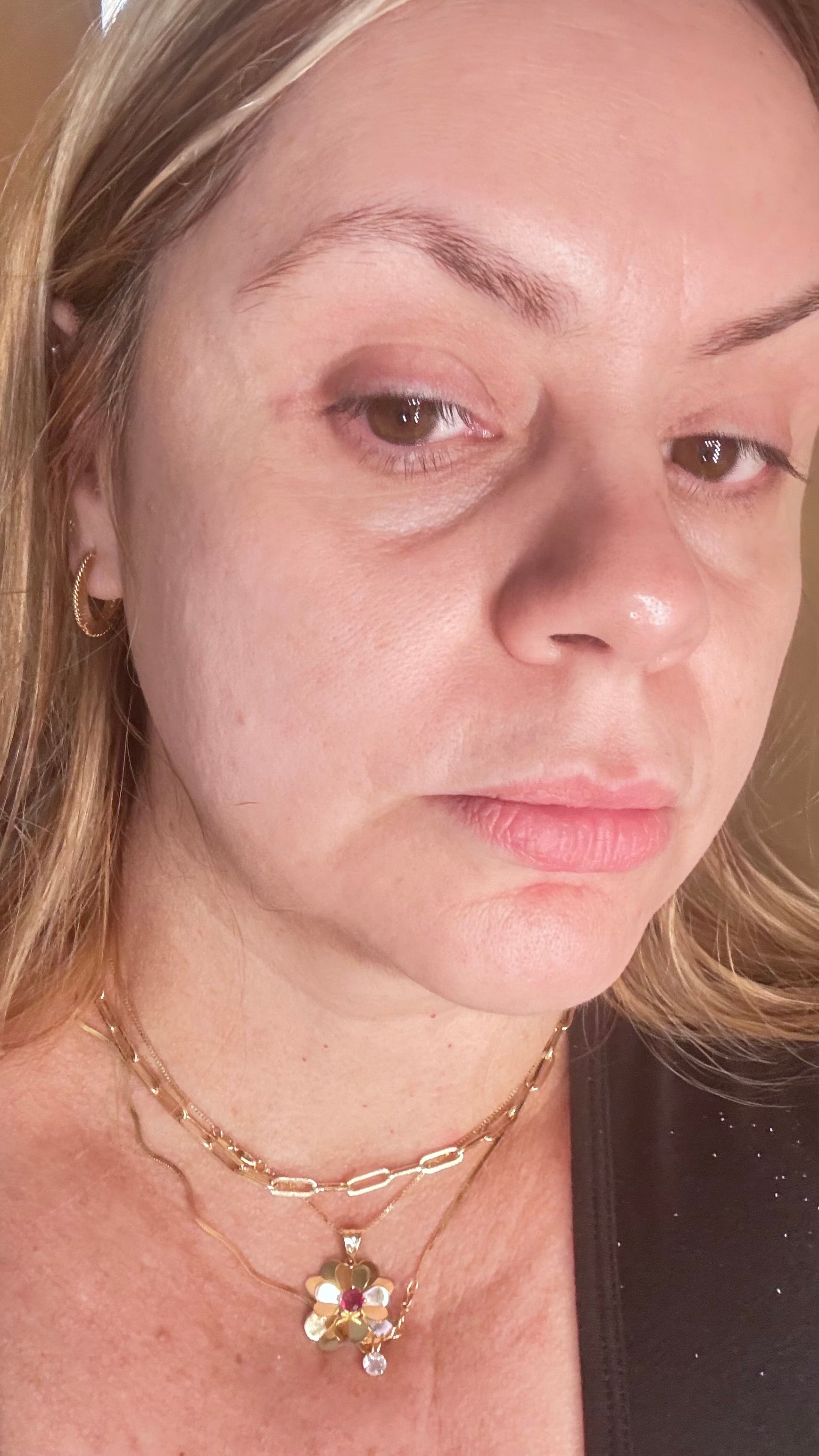 BBGLOW results after treatment 