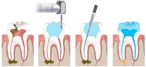 terapia canalare