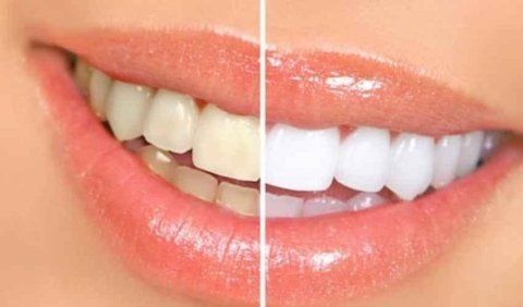 sbiancamento denti