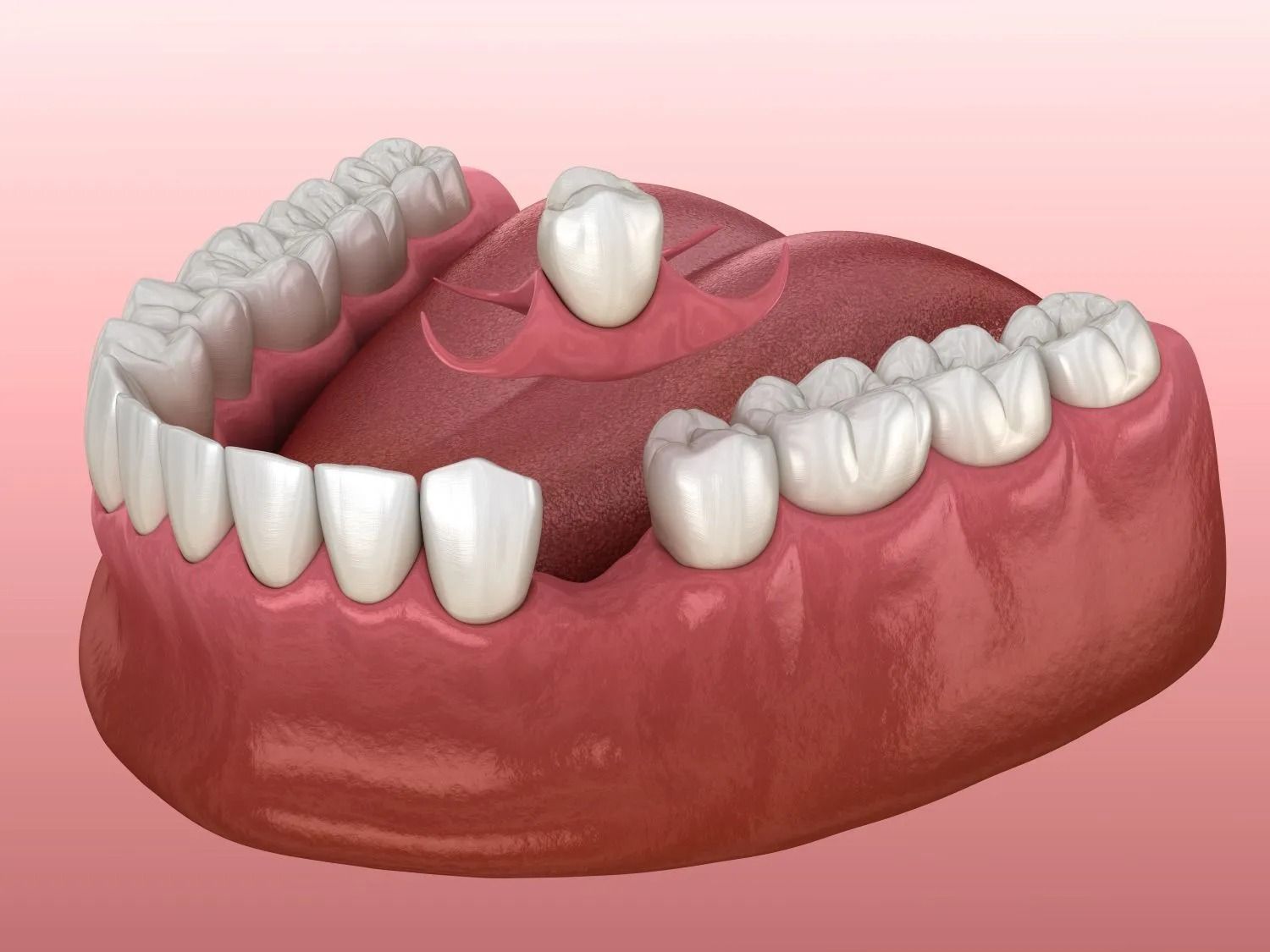 Hand holding dental model showing a denture attached to two implants. Pink gums, white teeth.