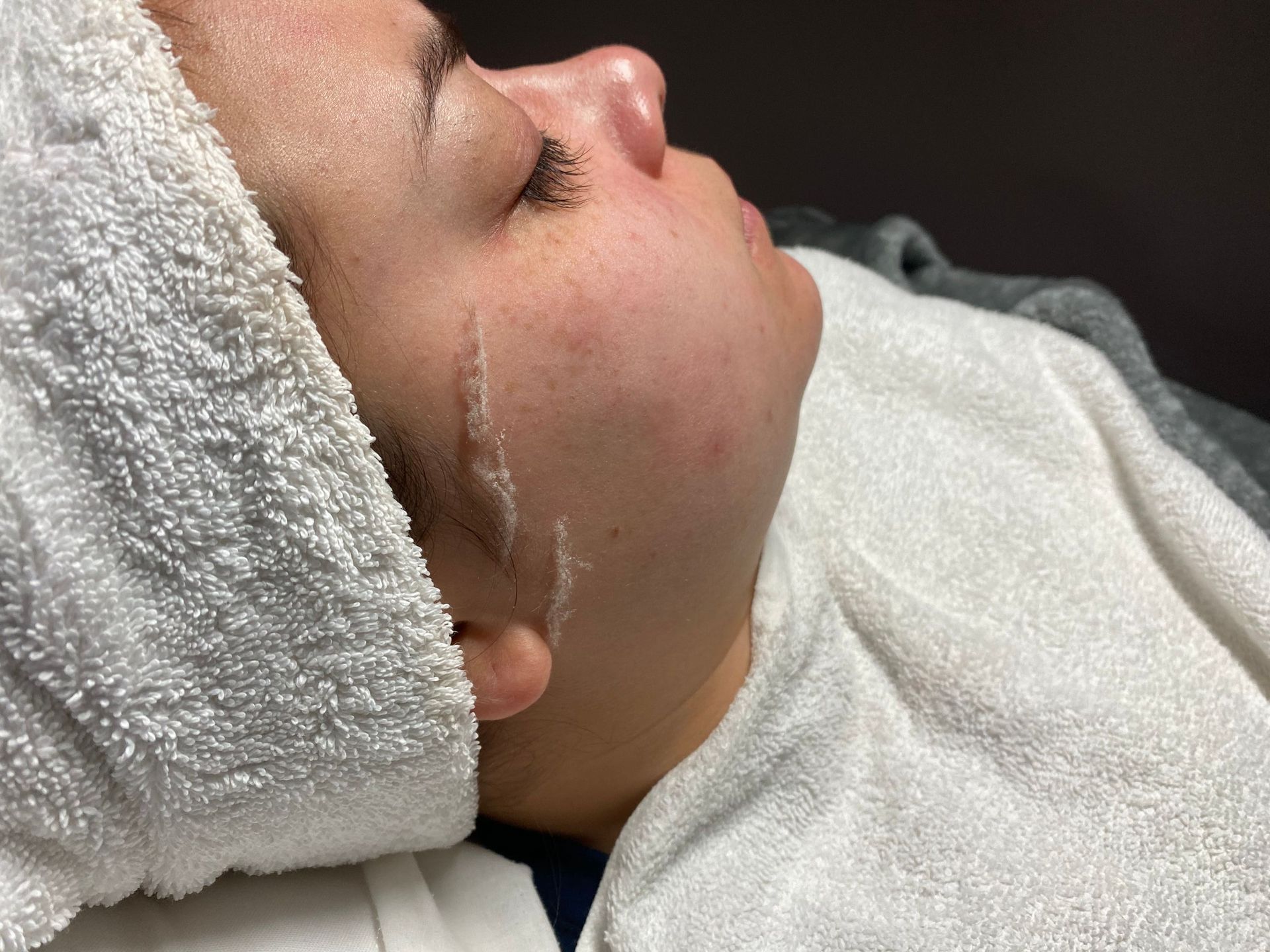 dermaplaning example