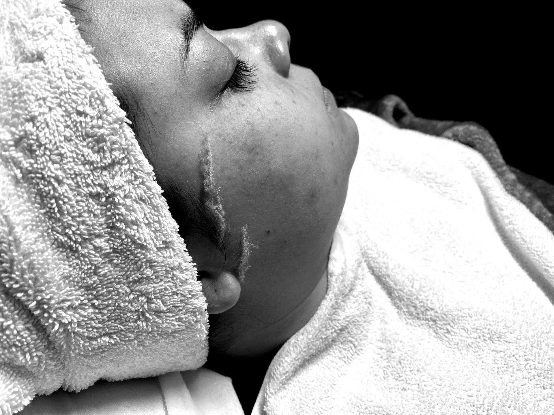dermaplaning example