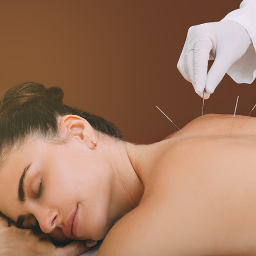 women getting acupuncture