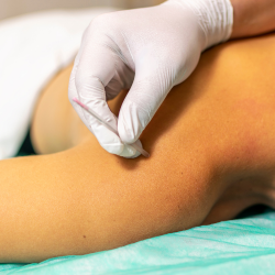 Person getting dry needling treatment